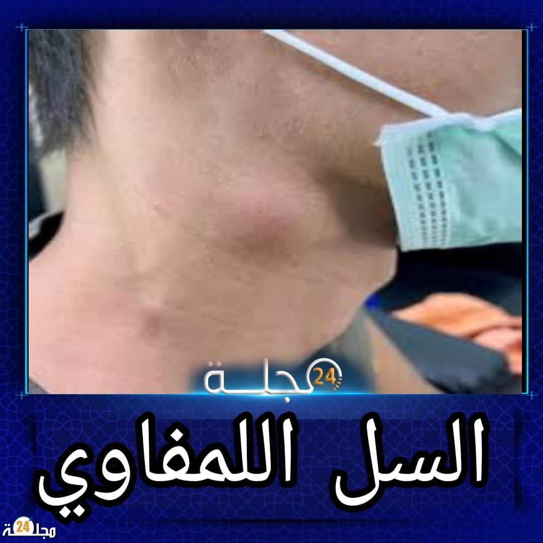 أزلو محمد يكتب: داء السل اللمفاوي: تحديات صحية ومعضلات تنموية في المغرب