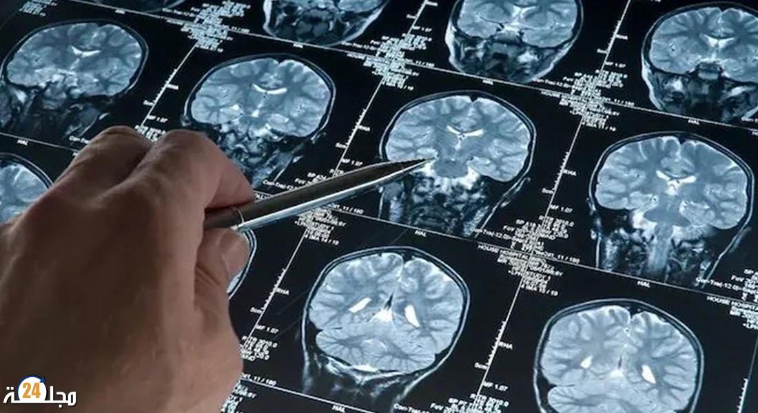 اكتشاف “المفتاح السحري” الذي يربط بين ألزهايمر والصرع
