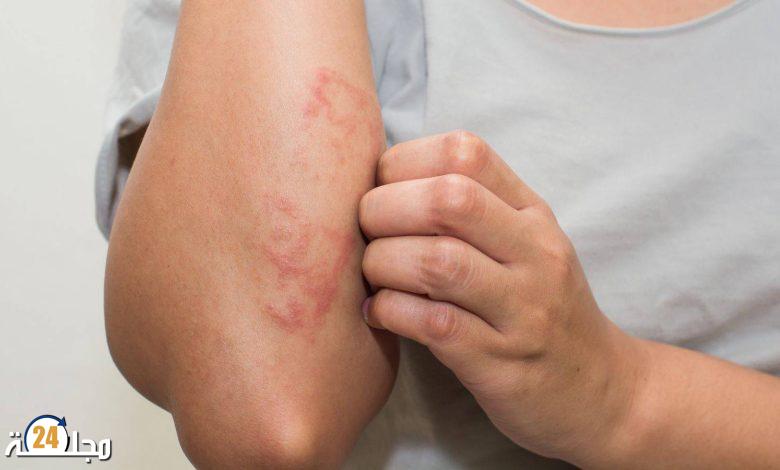 دراسة تكشف عن ارتباط الإكزيما بأمراض الكلى المزمنة