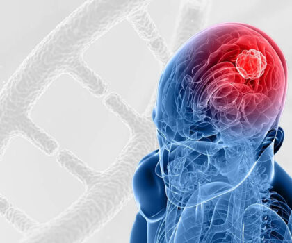 طريقة مطورة لعلاج أحد أخطر أورام الدماغ