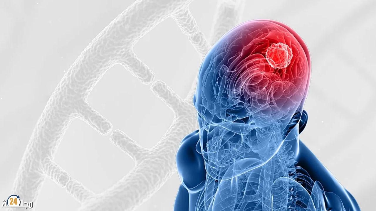 طريقة مطورة لعلاج أحد أخطر أورام الدماغ