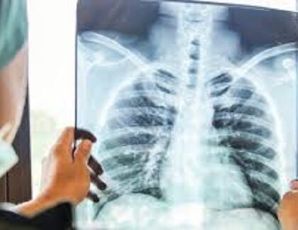 الشبكة المغربية للدفاع عن الحق في الصحة تحذر من تدهور وبائي خطير لداء السل بالمغرب