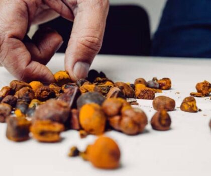 دراسة طبية جديدة تربط بين الإفراط في استهلاك السكر والإصابة بحصوات المرارة