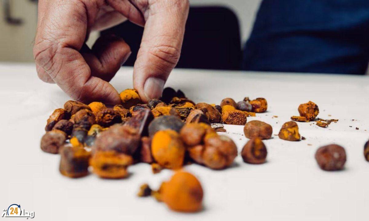 دراسة طبية جديدة تربط بين الإفراط في استهلاك السكر والإصابة بحصوات المرارة